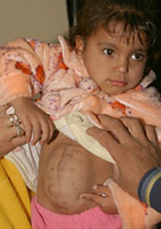 Scraps of shrapnel from a U.S. tank shell were embedded
in 3-year-old Alaa' Khalid Hamdan's eyes, reducing her
eyesight to almost nothing. Iraqi doctors believed she
wouldn't survive and were reluctant to waste scarce
bandages; their hasty stitching left her abdominal wall
incompletely rejoined. No More Victims brought her to
Florida for additional treatment, including partial
restoration of her eyesight.