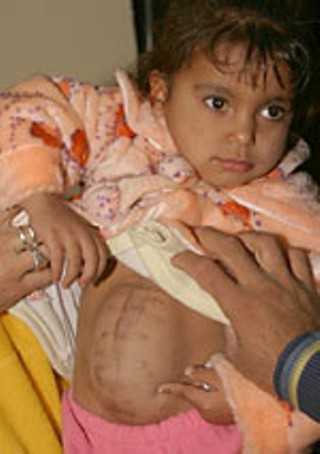 Scraps of shrapnel from a U.S. tank shell were embedded 
in 3-year-old Alaa' Khalid Hamdan's eyes, reducing her 
eyesight to almost nothing. Iraqi doctors believed she 
wouldn't survive and were reluctant to waste scarce 
bandages; their hasty stitching left her abdominal wall 
incompletely rejoined. No More Victims brought her to 
Florida for additional treatment, including partial 
restoration of her eyesight.