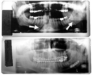 These X-rays of David Prater?s teeth and jaw show his condition following the prison beating (top) and after reconstructive surgery (bottom). Arrows in the top X-ray indicate complete breaks in jaw; the bottom X-ray shows titanium plates and teeth wiring used for reconstruction.